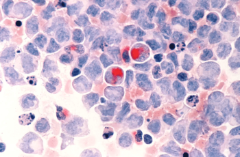 40 pessoas são diagnosticadas com câncer por minuto. Exames importantes no diagnóstico 