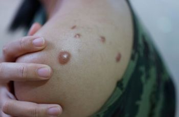 Como saber se tenho Mpox?