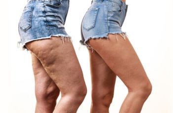 Que exame fazer para identificar lipedema?