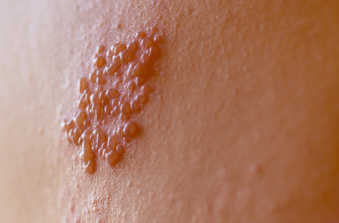 Descubra o que é a Herpes Zoster!